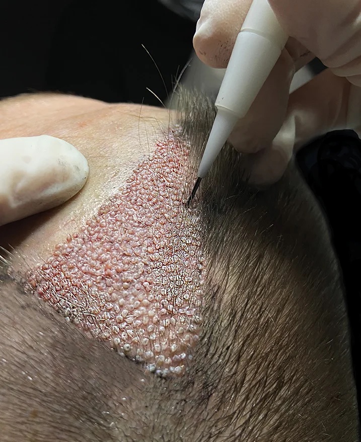 Primo piano di un punzone motorizzato che solleva singole unità follicolari dall'area donatrice rasata sulla parte posteriore della testa di un paziente non identificato.
