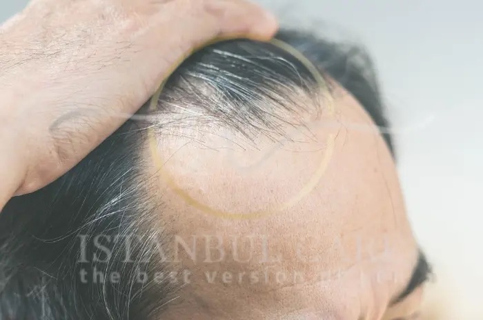 Gloved hands parting the hair on an unidentified person's scalp to expose the skin and the base of the strands underneath.