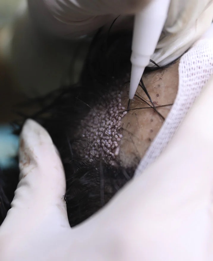 Una penna implantatrice tenuta in una mano guantata che posiziona un singolo innesto sul cuoio capelluto di un paziente non identificato, con innesti posizionati visibili intorno.