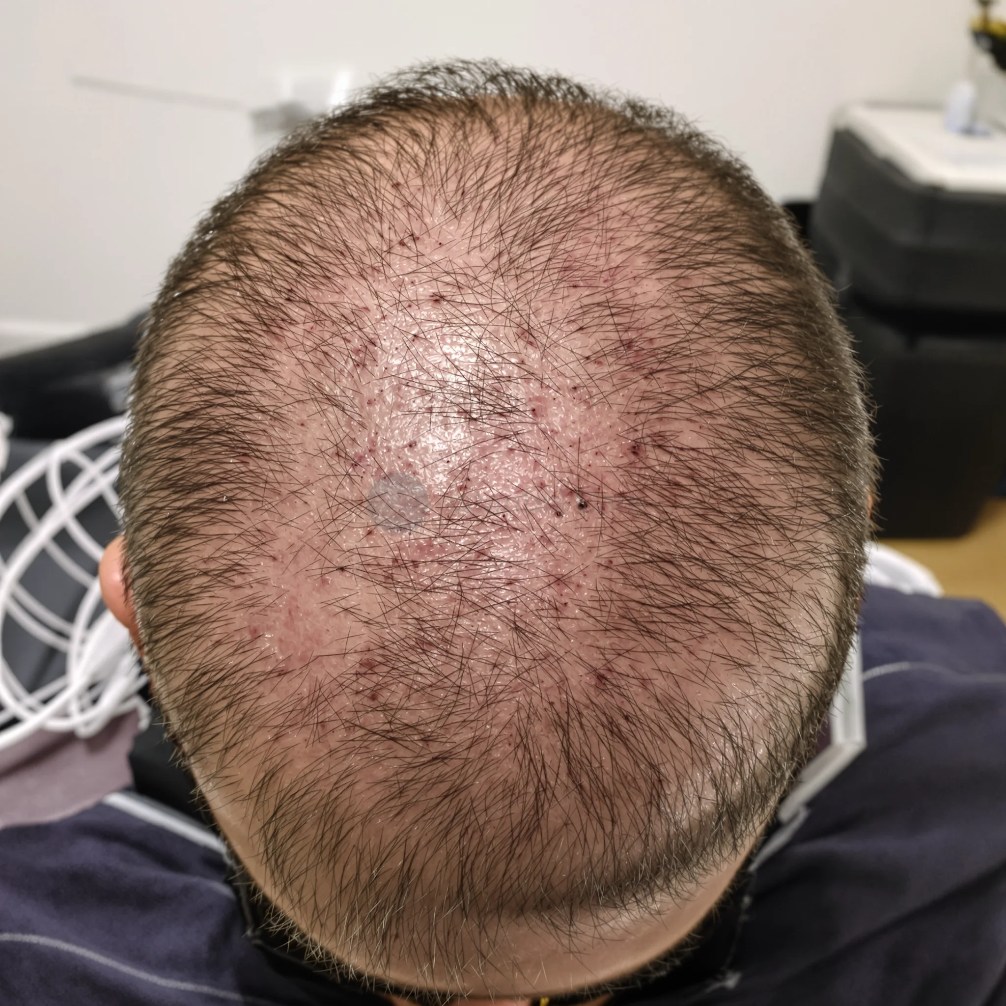 Preguntas médicas y prácticas antes de elegir un trasplante capilar en Turquía — Organizar la atención posterior; Revisar documentos antes del viaje – featured image from Istanbul Care