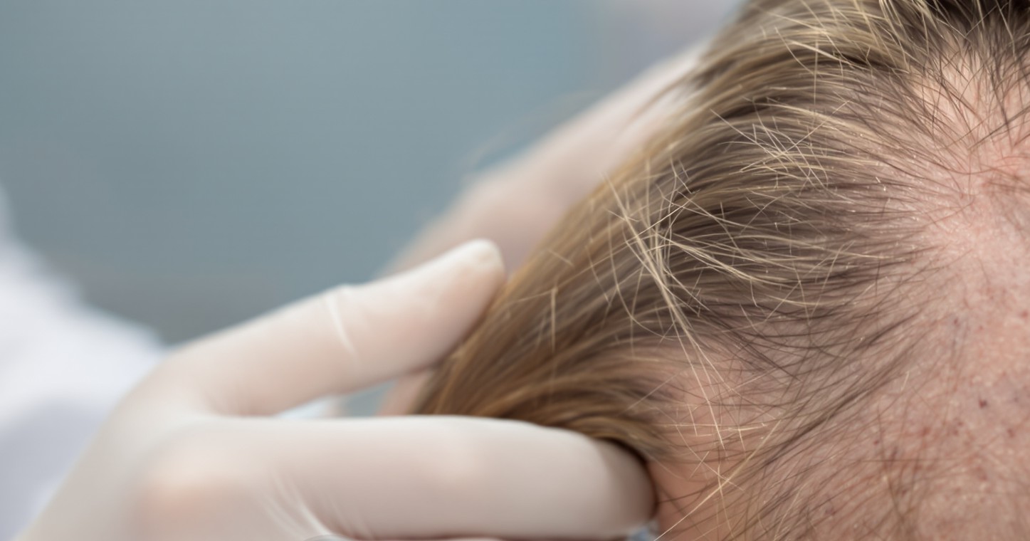 Una mano guantata che divide i capelli sulla parte anteriore del cuoio capelluto di una persona non identificata sotto luce diretta, così da rendere visibile la pelle tra i capelli.