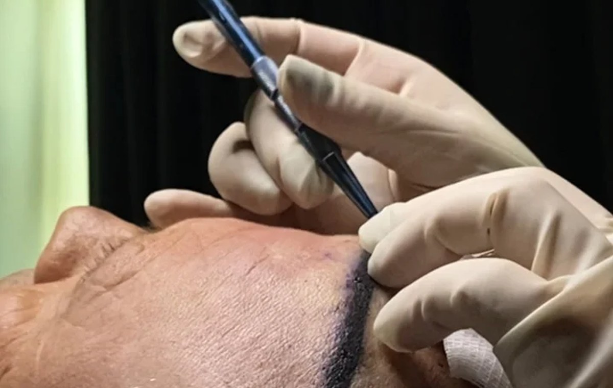 Gloved hands guiding an implanter pen along a marked hairline during a hair transplant procedure