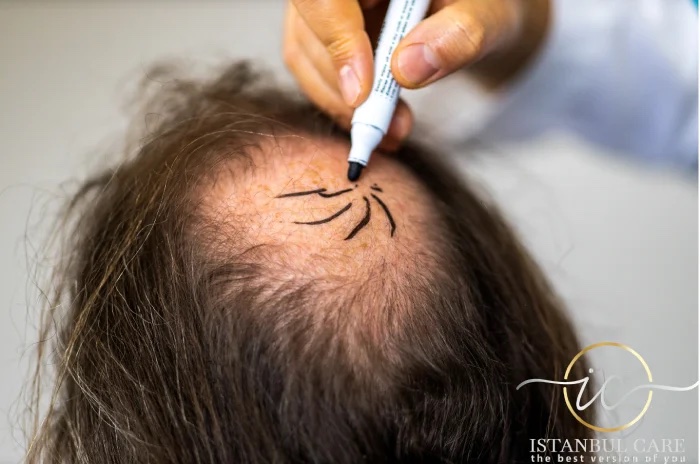 Una mano che disegna una linea dell'attaccatura curva con un pennarello chirurgico sulla fronte di un paziente non identificato con capelli radi sulla parte anteriore.