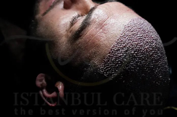 Close-up of a freshly implanted hair transplant area showing the tiny dot-like graft points that later fade – Istanbul Care