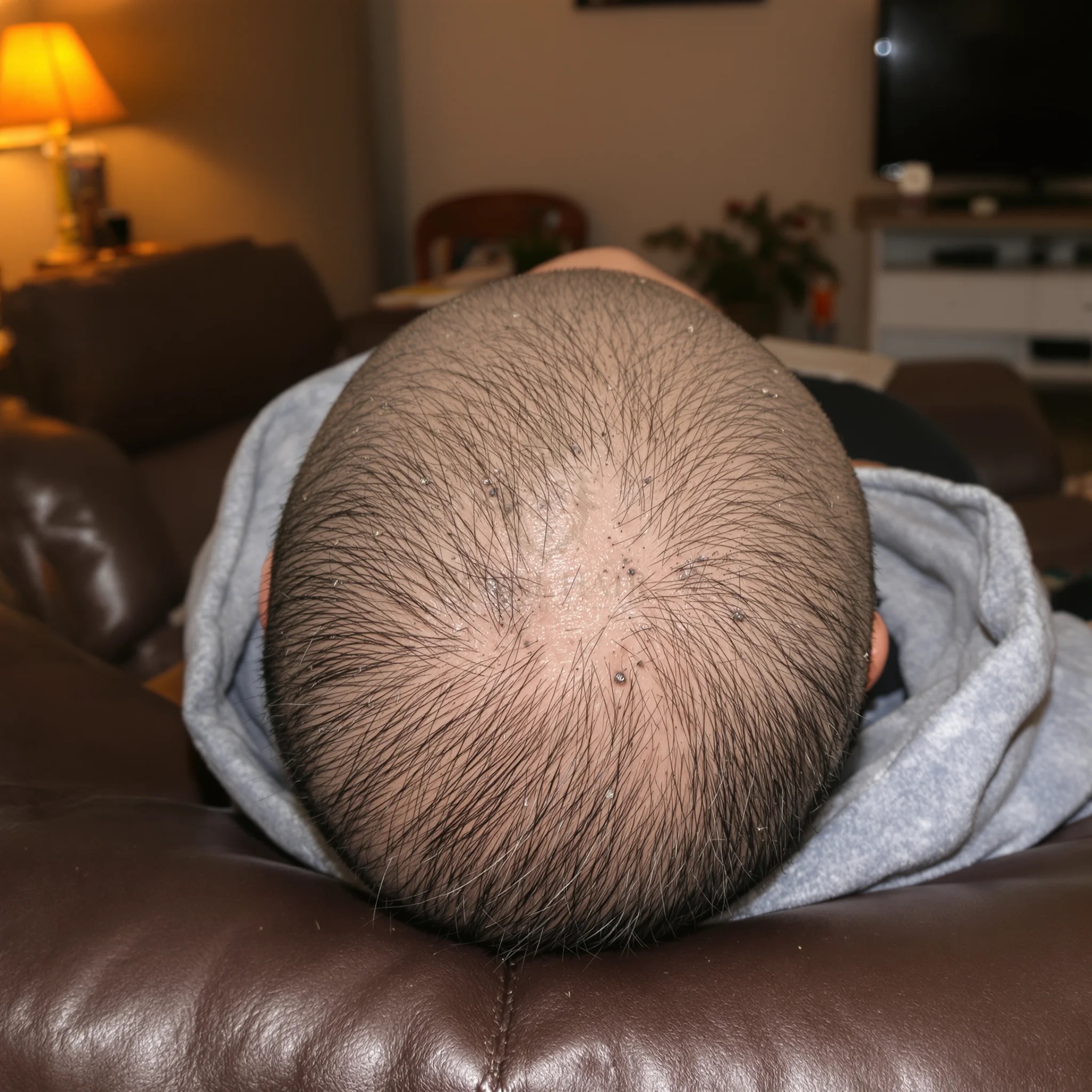 La parte posteriore e superiore della testa di un uomo non identificato vista dall'alto mentre è sdraiato a faccia in giù, che mostra il cuoio capelluto nudo sulla sommità e i capelli rimanenti sui lati e sulla parte posteriore.