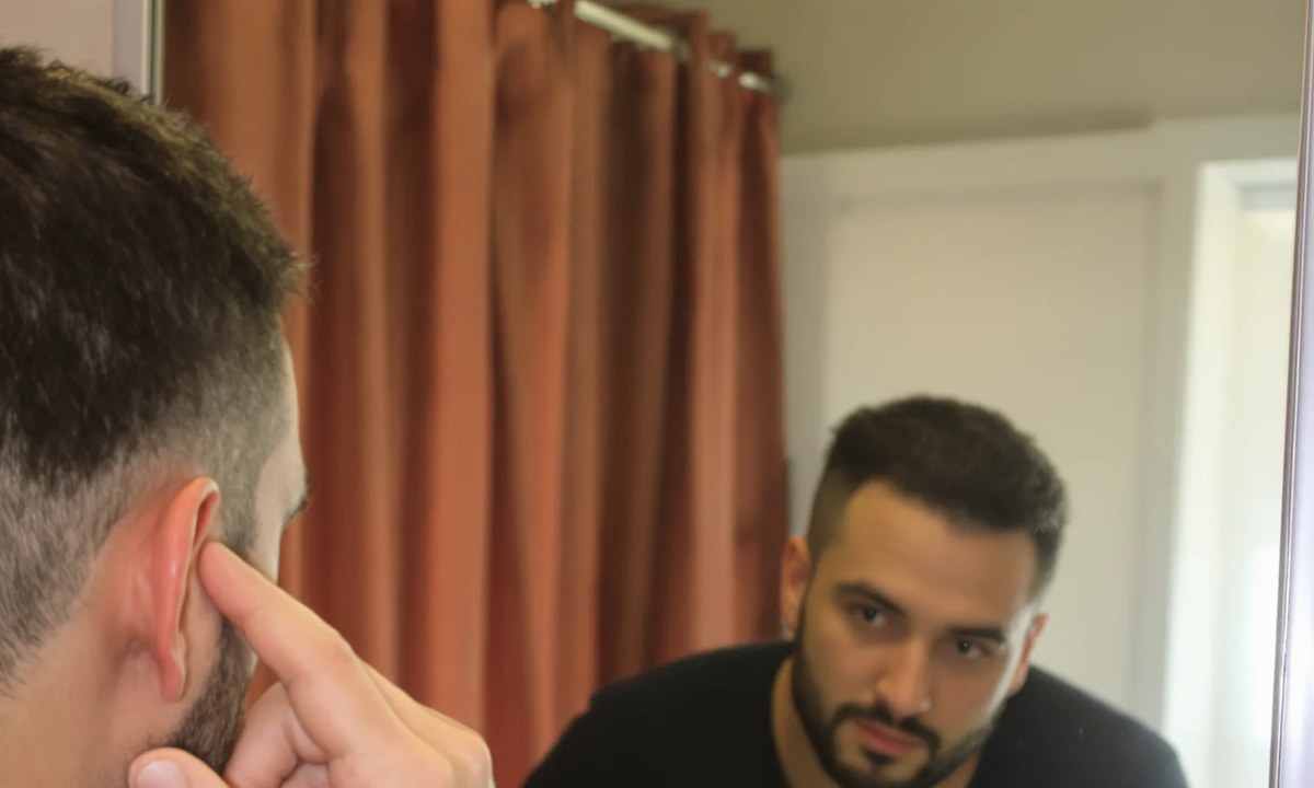 Man examining his temple and hairline in a bathroom mirror between treatment sessions