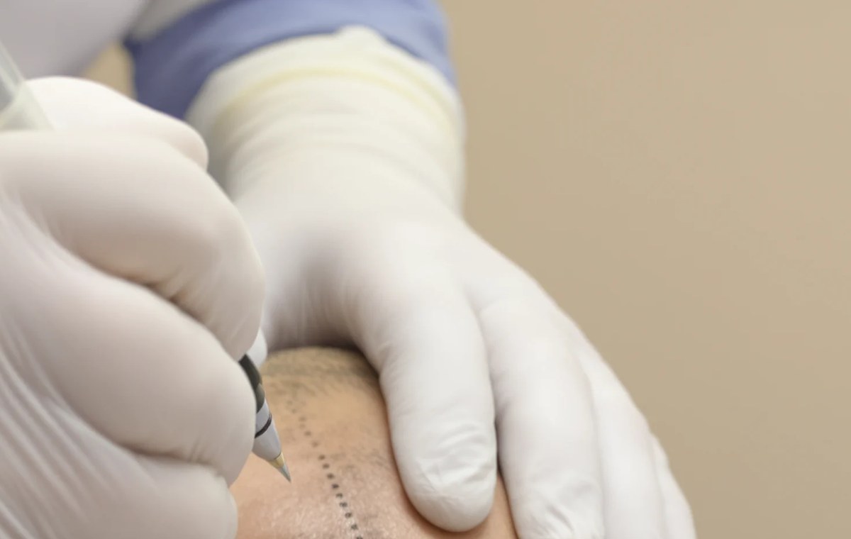 Surgeon in white gloves drawing a dotted hairline design on a shaved scalp before a hair transplant