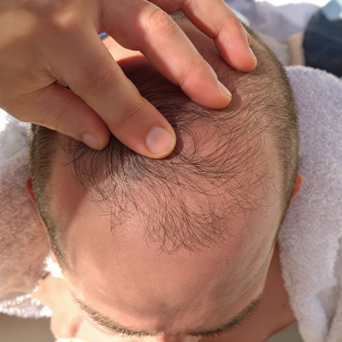 Close-up top view of a man’s frontal scalp with fingers parting sparse hair to show thinning between the temples