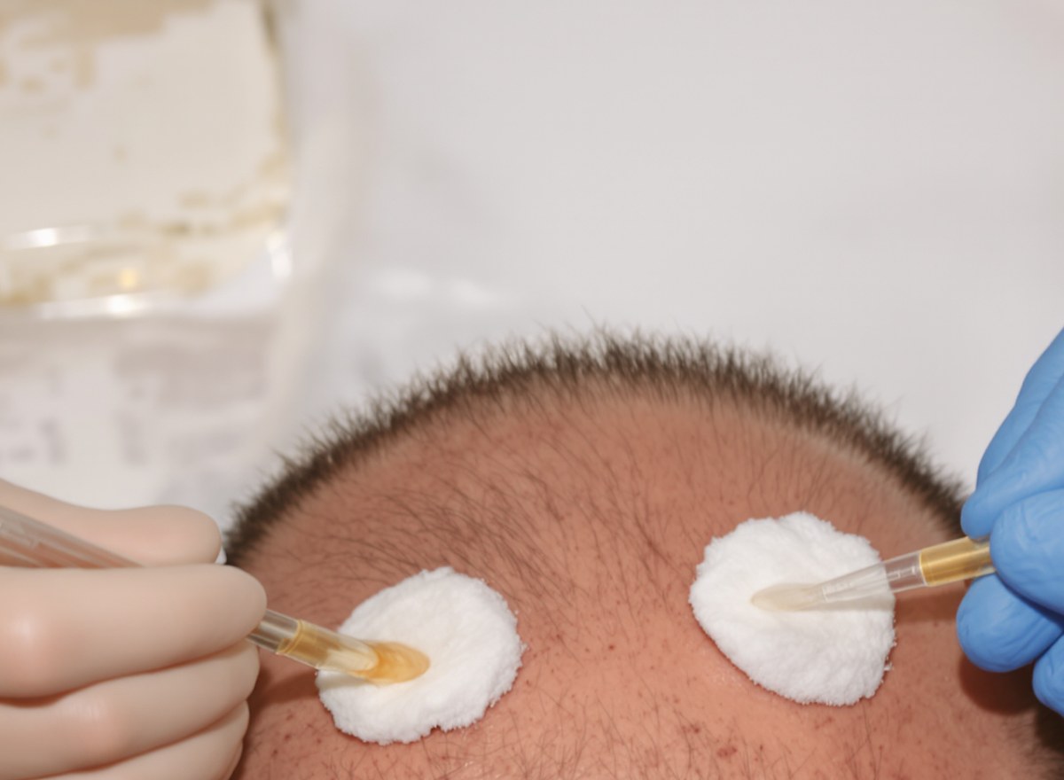 Two gloved hands applying an amber solution with pipettes onto cotton pads placed on a balding scalp