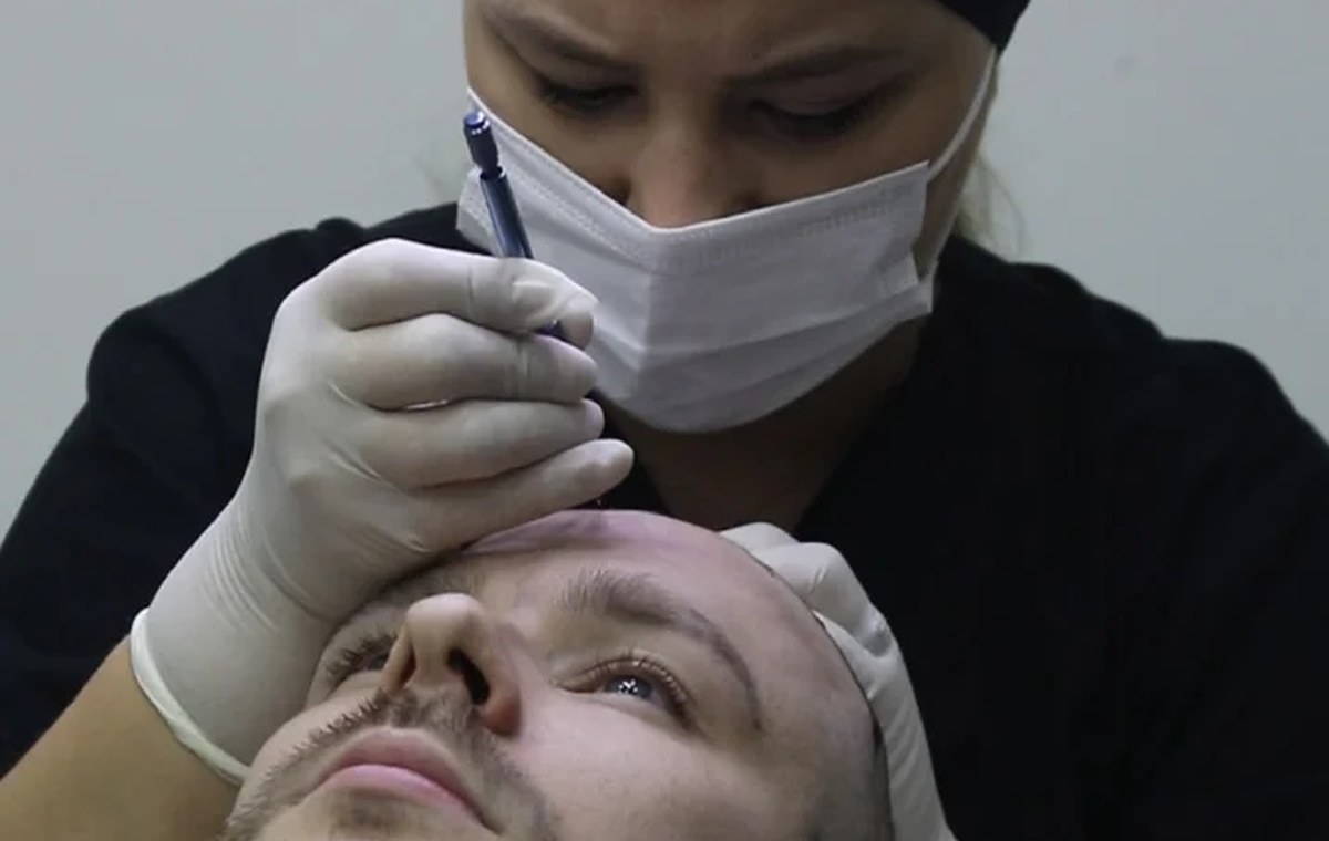 Masked clinic nurse using an implanter pen along the hairline of a patient during a hair transplant