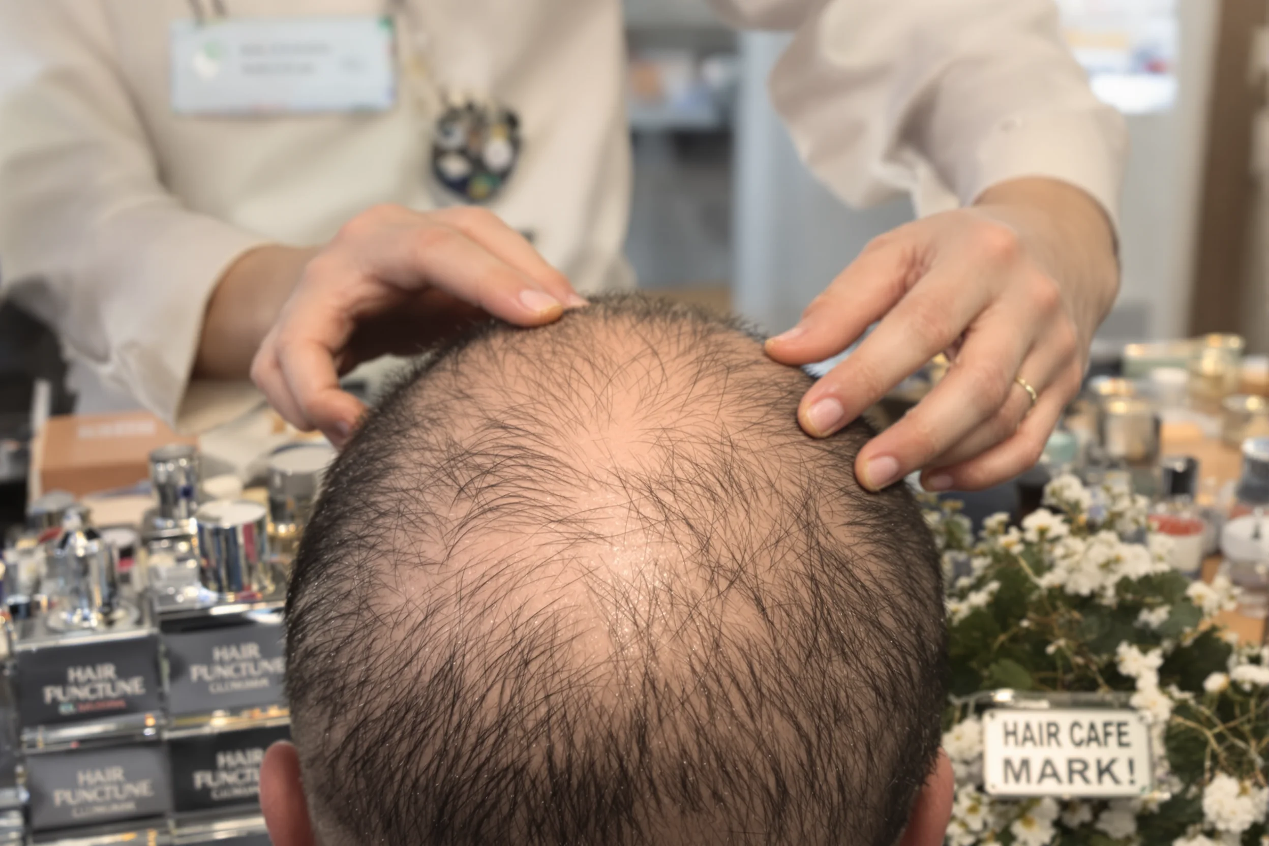 Turkey Hair Transplant for Scarred Scalps: What Works