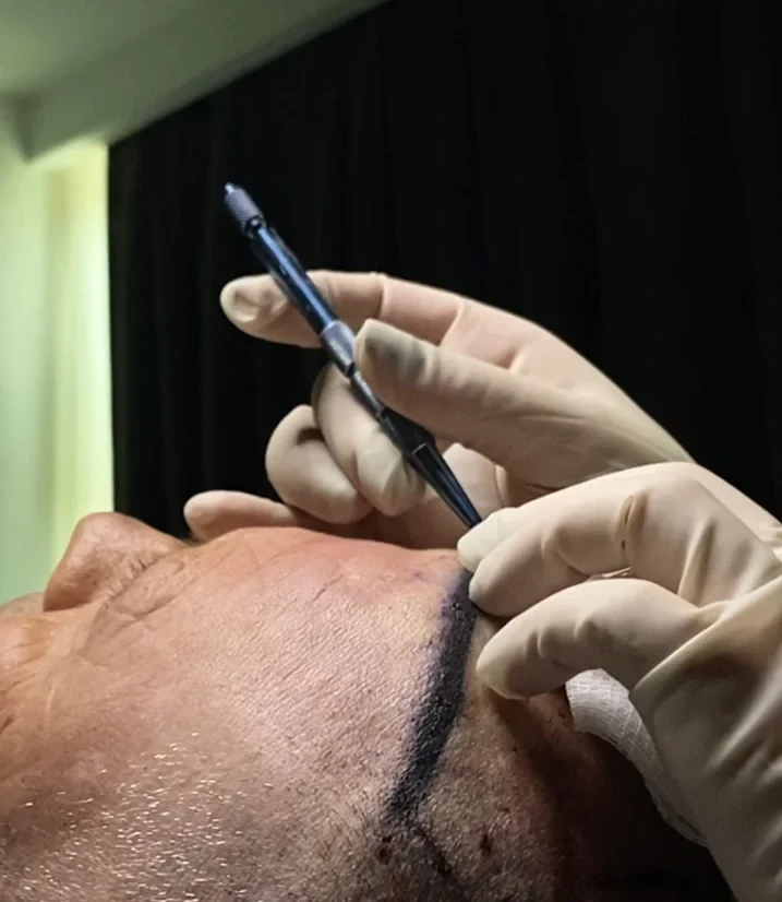 Close-up of two gloved hands at a patient's forehead; one holds a slim metal pen-style blade just above a dark surgical marker line drawn across the hairline.