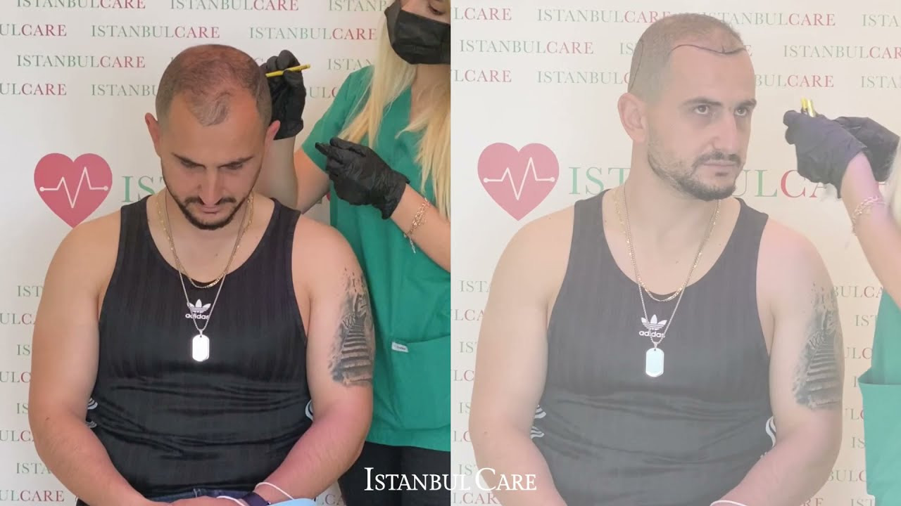 Questions to Bring to a Shortlisted Hair Transplant Clinic — Get the money and follow-up in writing, Clarify the proposed design Questions to Bring to a Shortlisted Hair Transplant Clinic — Get the money and follow-up in writing, Clarify the proposed design – featured image from Istanbul Care