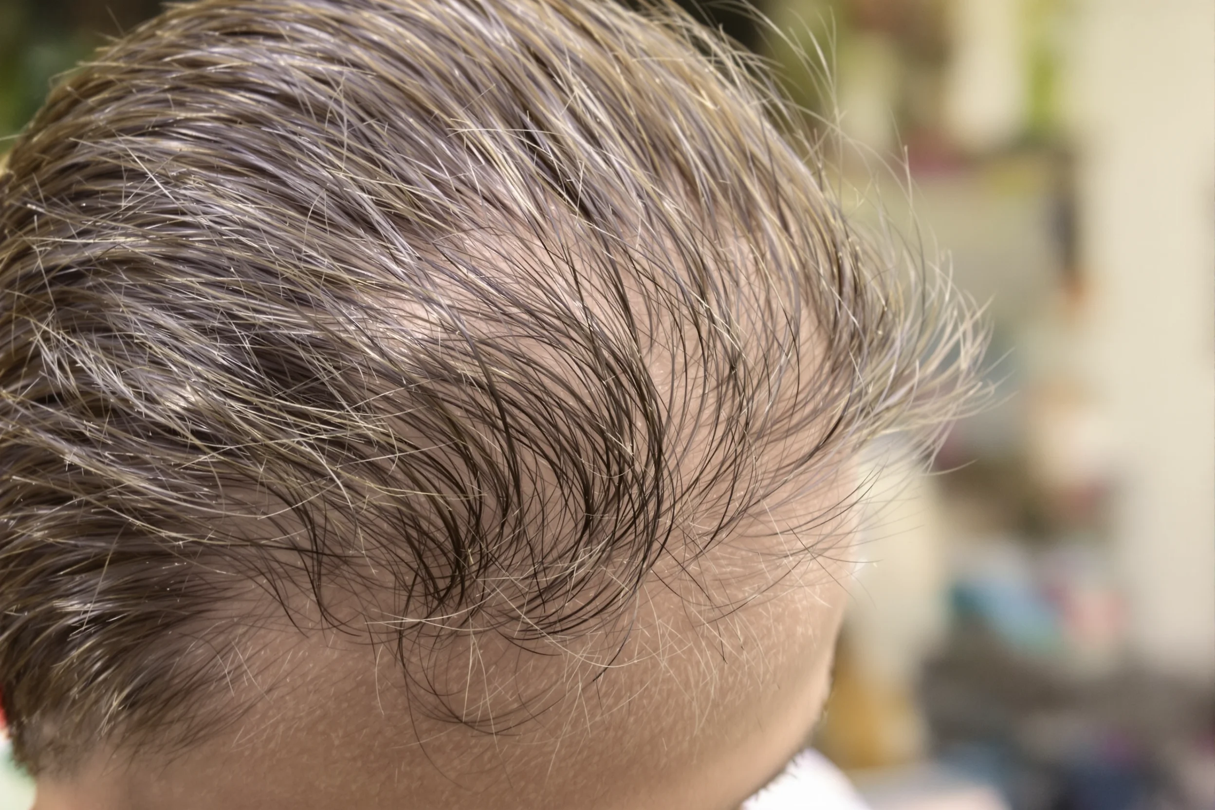 Dare una risposta personale, non universale, Concludere con criteri personali — Che cosa significa migliore per il tuo trapianto di capelli in Turchia – featured image from Istanbul Care