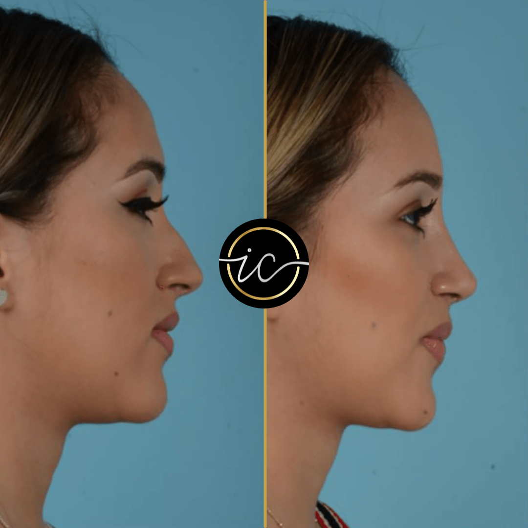 rhinoplasty Istanbul before after