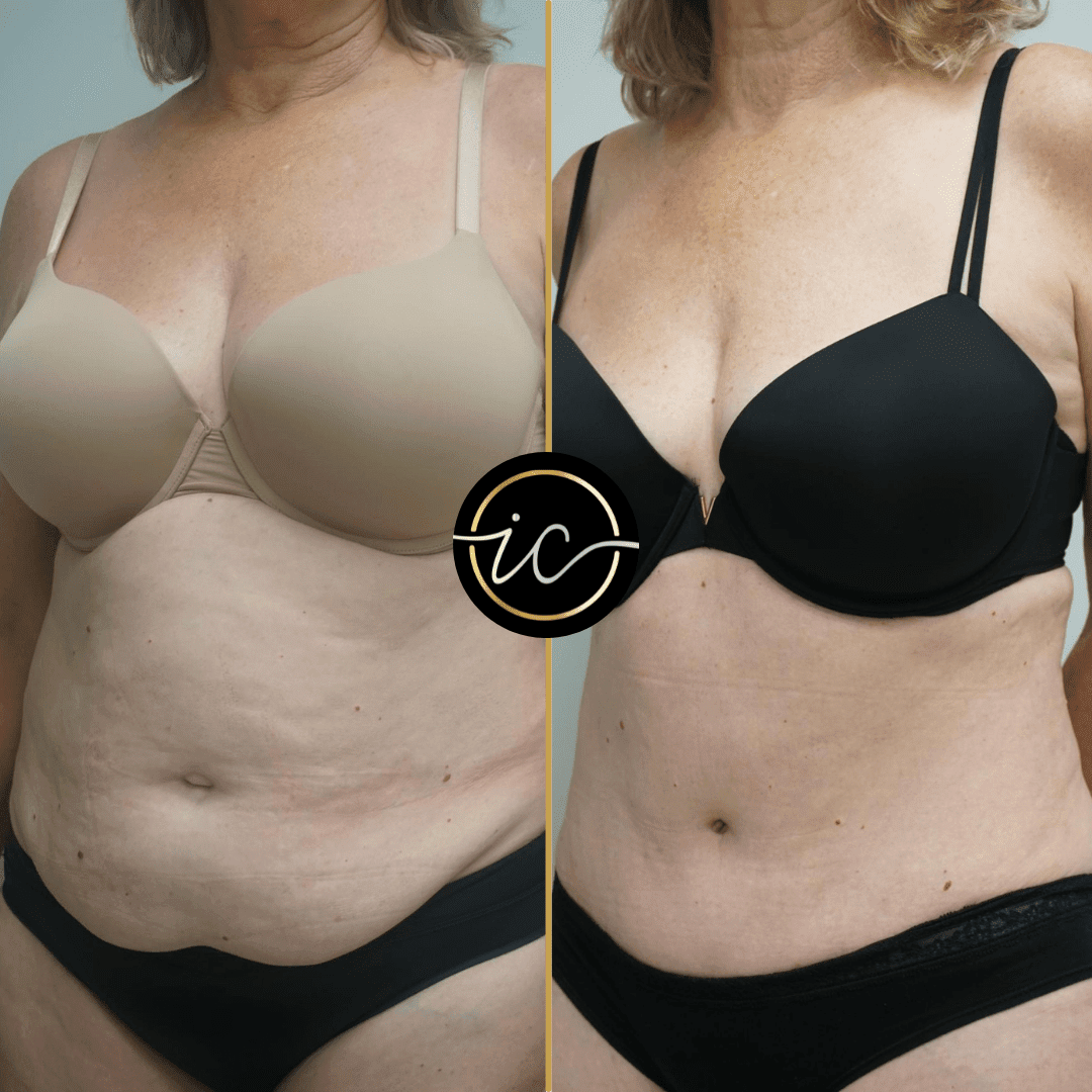 Mega Liposuction Turkey Before & After