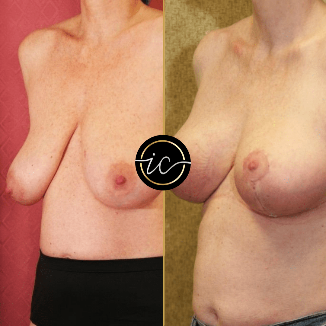 Breast Lift Istanbul Before After