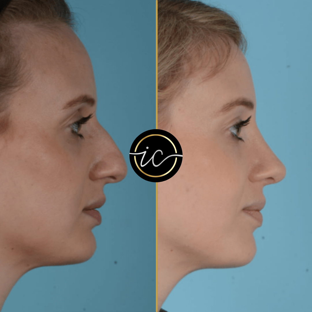 rhinoplasty Istanbul before after
