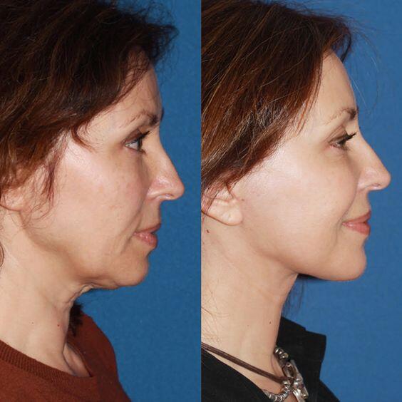 Everything You Should Know About Having a Facelift in Turkey