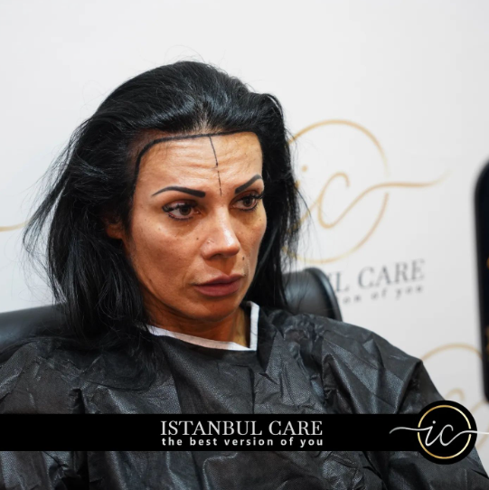 Hair transplant for women in Albania