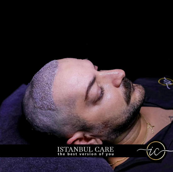 Common Causes of Hair Transplant Failure