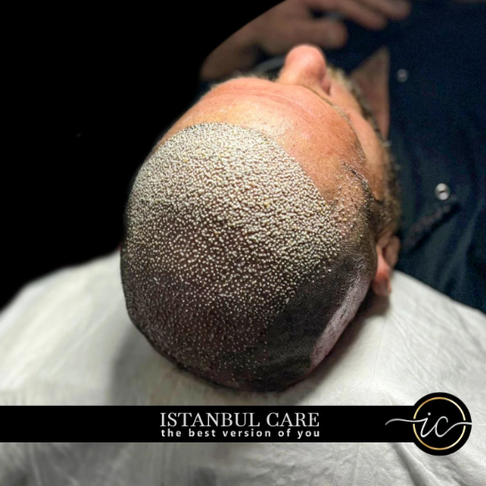 How to Care for Your Scalp After a Hair Transplant