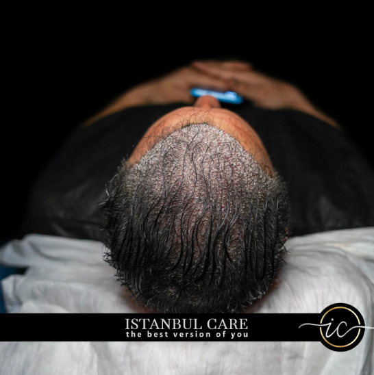 Are Hair Transplants Detectable? How Natural Can It Look?