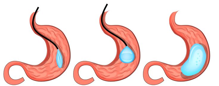 Discover the benefits of getting a gastric balloon in Turkey. Affordable, effective weight loss solutions with expert care.