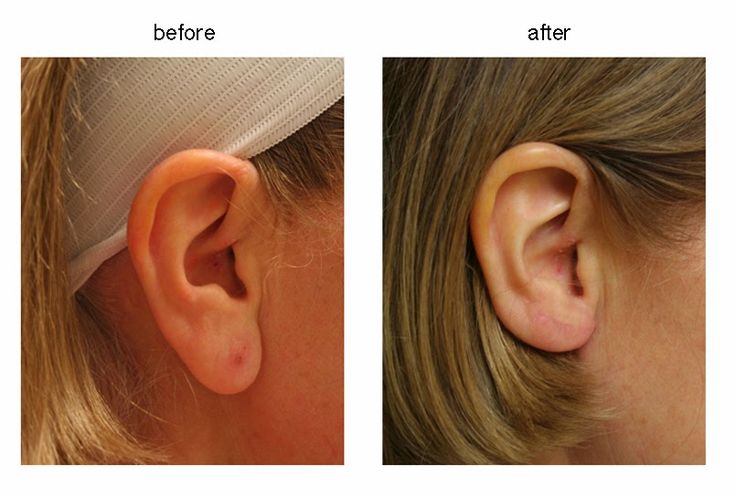 Discover why Turkey is a top destination for ear reshaping surgery with expert surgeons, affordable prices, and quality care.