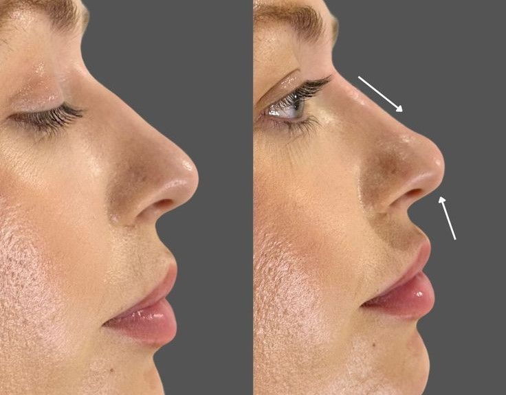 Discover the benefits of rhinoplasty in Istanbul, a global hub for expert surgeons, affordable prices, and exceptional care.