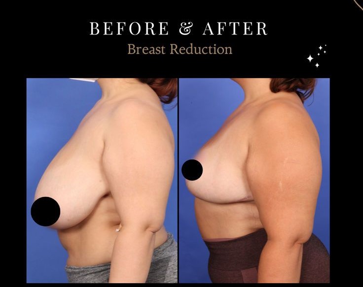 Breast Reduction in Turkey: The Whole Procedure