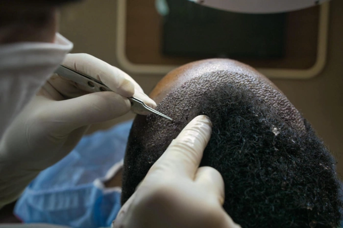transplantimi i flokëve afro