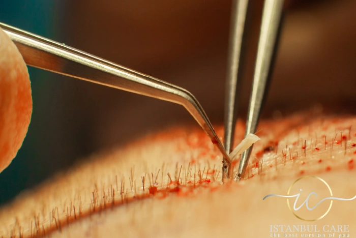 body-hair-transplants-turkey-istanbul