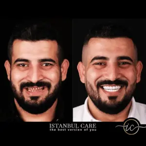 cirugía plástica antes y después - Tratamiento dental Antes y Después en Turquía dental treatment before after