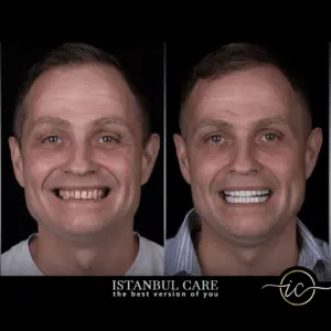 cirugía plástica antes y después - Tratamiento dental Antes y Después en Turquía dental treatment before and after
