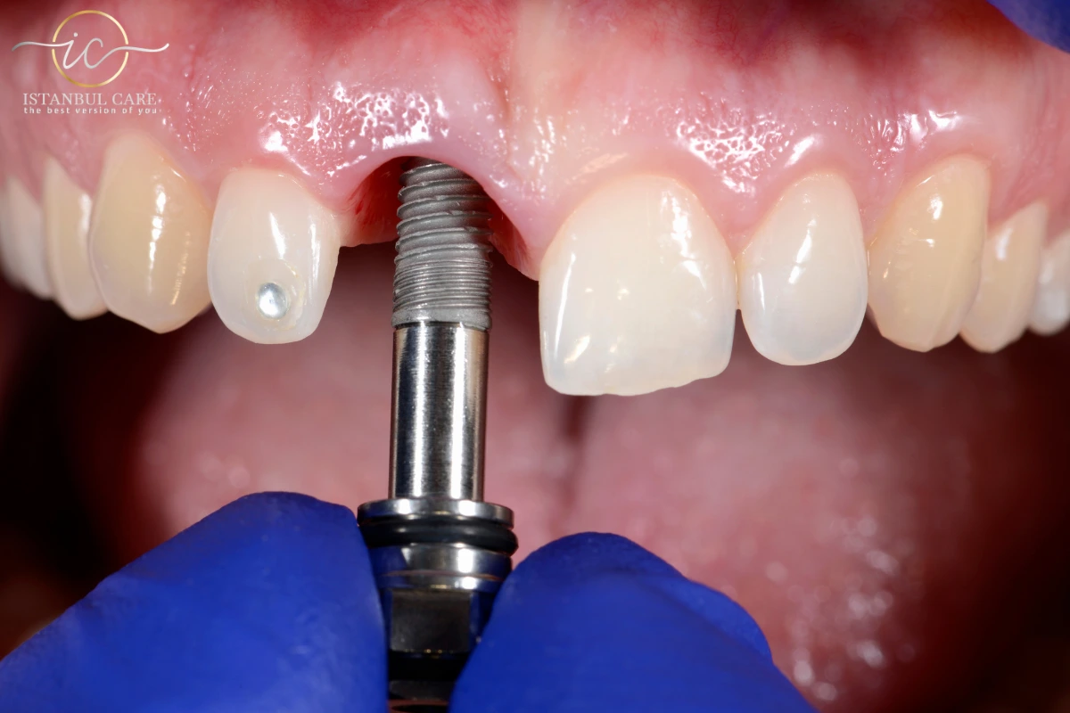 Dental Implant in Turkey