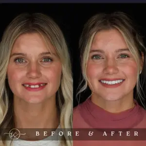 cirugía plástica antes y después - Tratamiento dental Antes y Después en Turquía cirugía plástica antes y después - Tratamiento dental Antes y Después en Turquía