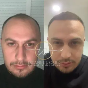 Transplant flokesh me safir FUE, transplant flokësh - Transplant flokësh me safir FUE dhi hair transplant
