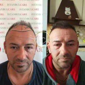 Transplant flokesh me safir FUE, transplant flokësh - Transplant flokësh me safir FUE dhi hair transplant istanbul care