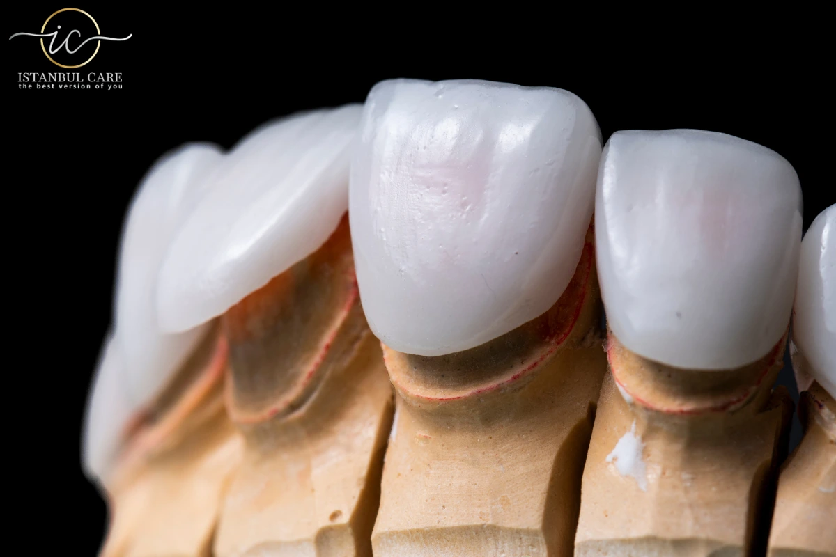 E-Max Veneers in Turkey