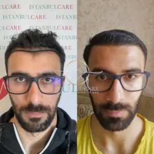 Transplant flokesh me safir FUE, transplant flokësh - Transplant flokësh me safir FUE fue hair transplant turkey