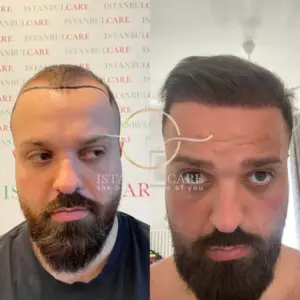 Transplant flokesh me safir FUE, transplant flokësh - Transplant flokësh me safir FUE fue hair transplant before and after