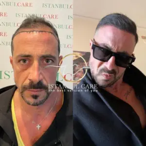 Transplant flokesh me safir FUE, transplant flokësh - Transplant flokësh me safir FUE fue hair transplant image