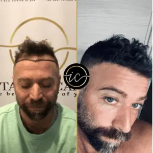 Transplant flokesh me safir FUE, transplant flokësh - Transplant flokësh me safir FUE fue hair transplant turkey before and after