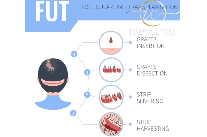 fut hair transplant-istanbul-care
