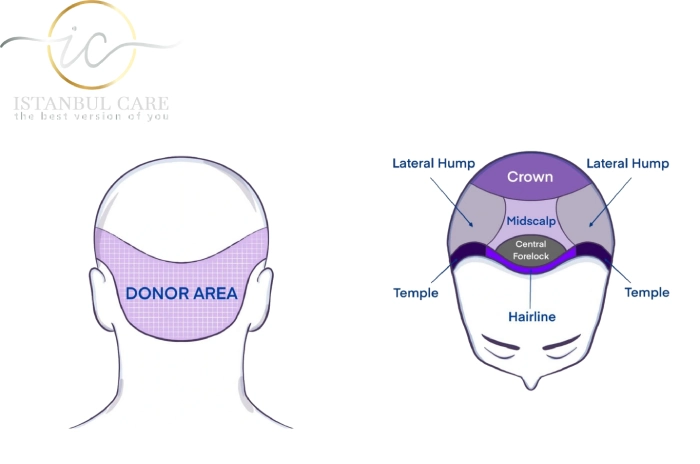 hair-donor-area-transplant