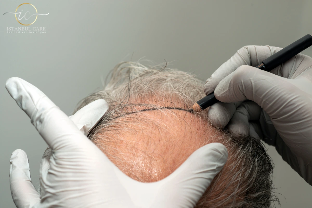 How Much Does Hair Transplant Cost in Turkey