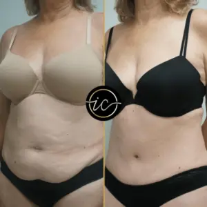 Mega Liposuction in Turkey