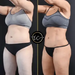 Mega Liposuction in istanbul-care