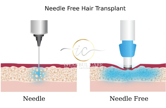 needle-free-hair-transplant-istanbul-care